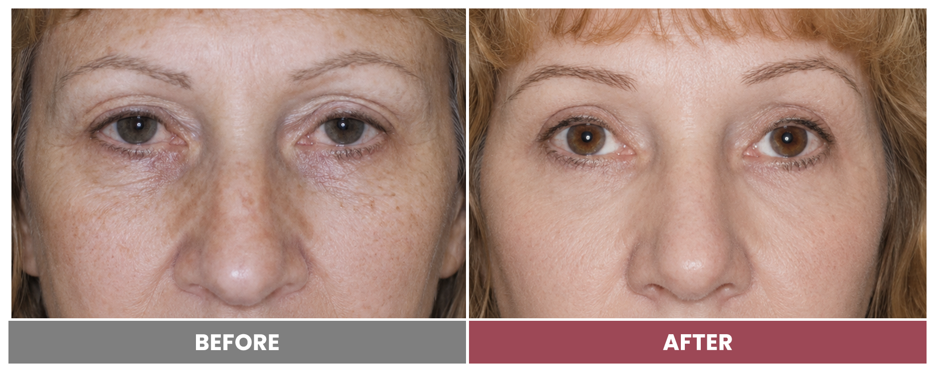 PTOSIS REPAIR - Case 16